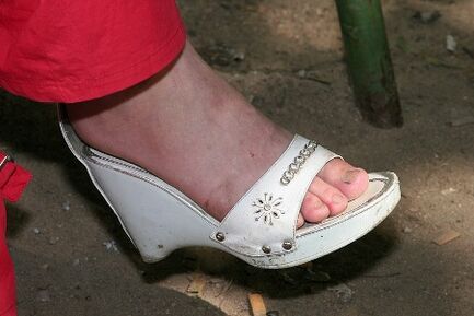 Tinkamos pėdų higienos trūkumas yra grybelio vystymosi priežastis
