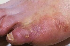 grybelinės infekcijos apraiškos ant kojų odos