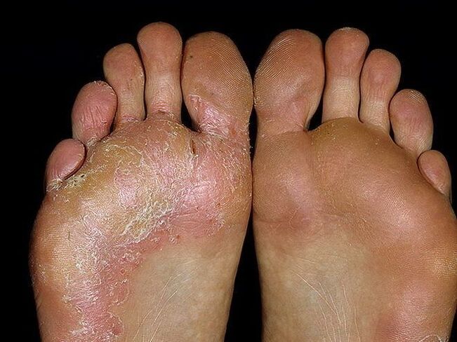 pėdos grybelio simptomai