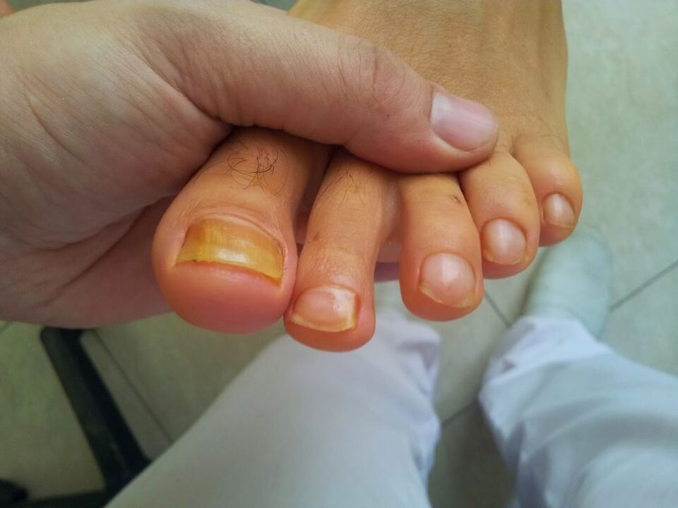 kojų nagų pageltimas nuo grybelio
