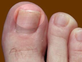 Kojų nagų grybelis – indikacija naudoti fungicidinius lašus