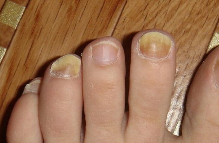 grybelio simptomai ant nagų ir pėdų odos