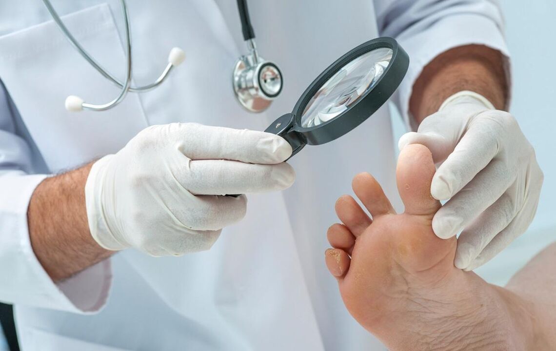 gydytojas apžiūri pėdas su grybeliu